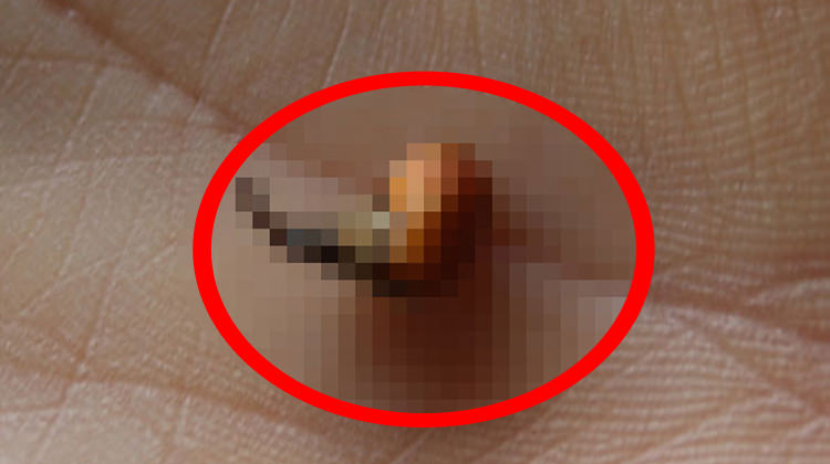13 yaşındaki kızın kulağından çıkan şey şoke etti 13 yaşındaki kızın kulağından çıkan şey şoke etti